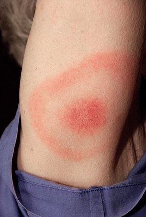 Bull's eye rash (Erythema migrans)